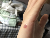 冷冻去疣什么感觉,冰爽一瞬，舒适恢复之旅
